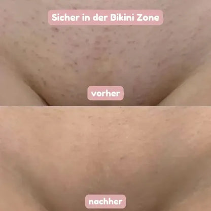 BloomSkin™ – Sanfter 2-in-1 Damenrasierer